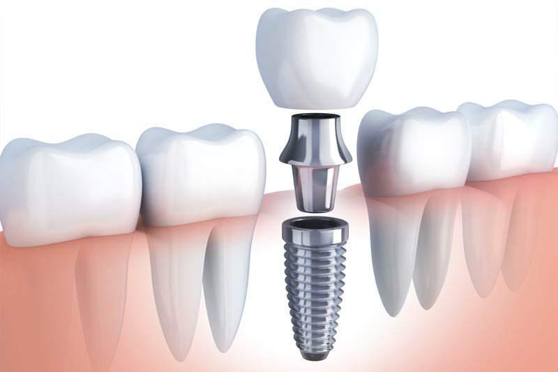 Implants Dentist in Omaha